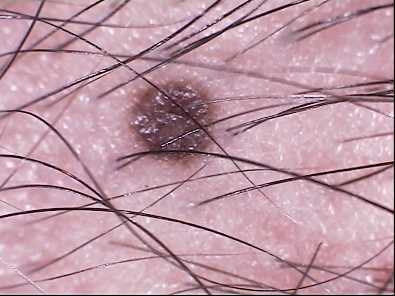 microderm pic1