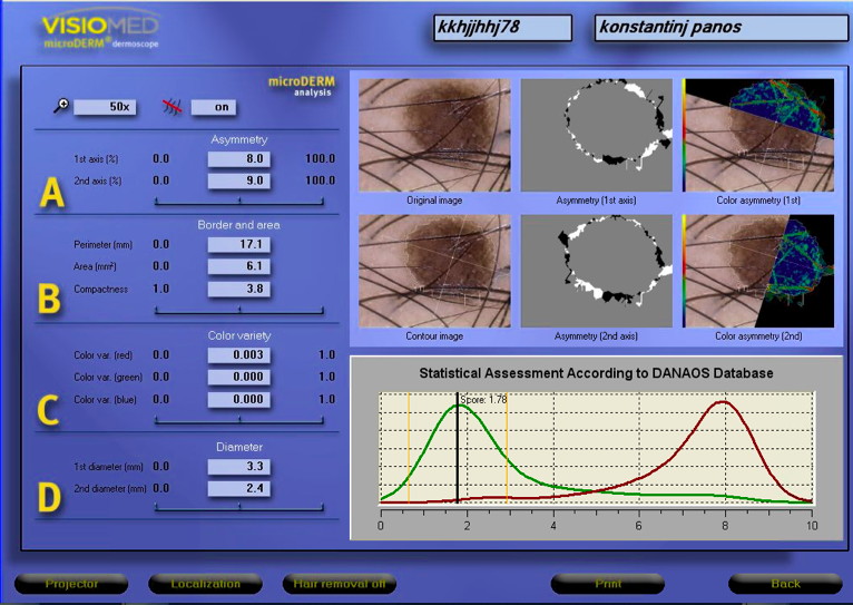 microderm pic4