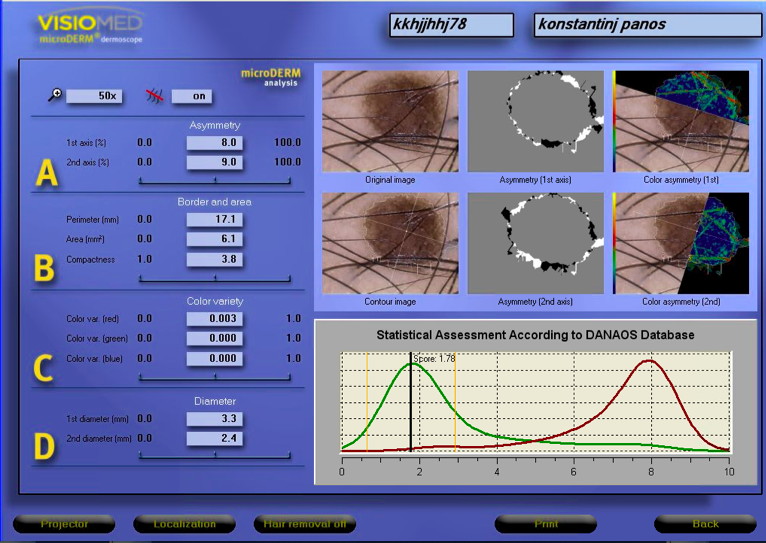 microderm pic4